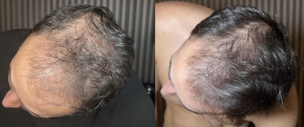 Before and after customer result: Hairline and crown · Customer progress