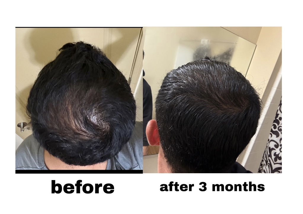 Before and after customer result: Crown density · Three-month progress
